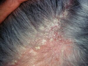 ROFLUMILAST – A new drug developed to treat Seborrheic Dermatitis