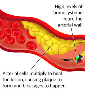 How higher level of Homocysteine lead to Increased risk of Coronary Artery disease in Youngsters?